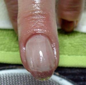 Traumanagel heute Fehlender Fingernagel, ist eine Modellage möglich? in Nagelkrankheiten