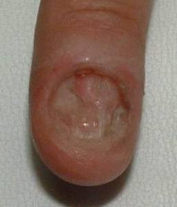 Traumanagel, abgebissen und abgeschält Fehlender Fingernagel, ist eine Modellage möglich? in Nagelkrankheiten
