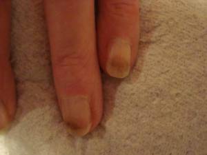 Der kleine und der Ringfinger der linken Hand meiner Mutter Greenie am freien Nagelende in Nagelkrankheiten