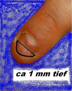So sehen ca. die Nägel aus, bisschen schlimmer sogar Nagelbeisser behandeln oder nicht in Nägel kauen