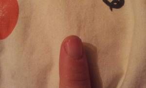 Finger kaputt :-( Welche modellage Art bei diesem Nagel? in Nagelkrankheiten