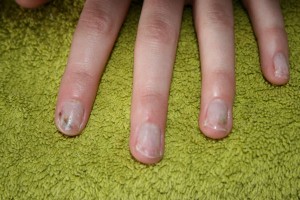 plaknagels2 Grüner Nagel unter Kunstnägeln in Nagelkrankheiten