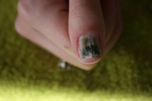 plaknagels3 Grüner Nagel unter Kunstnägeln in Nagelkrankheiten