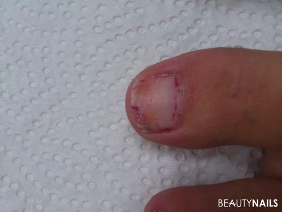 Fuß Nägel - vorher Vorher / Nachher - Sehr kaputte, eingerissene und vom Nagellack verfärbte Nägel. Nailart
