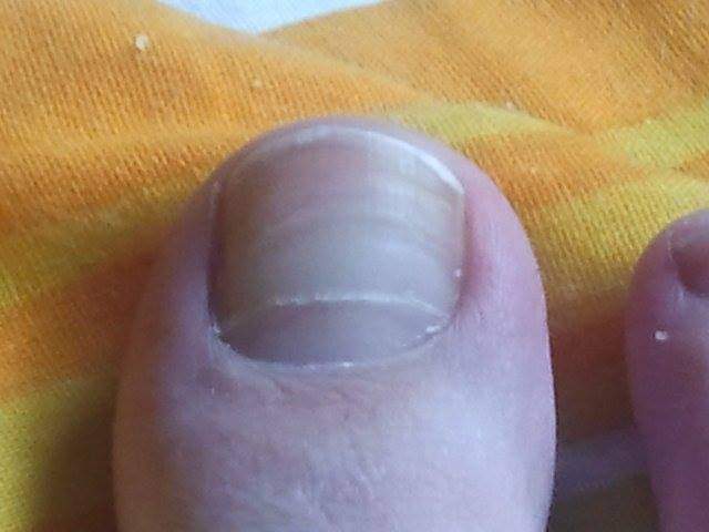 Nagel rechts 1 Komisch aussehende Nägel, wächst ein neuer Nagel? in Nagelkrankheiten