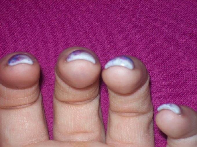 Tunnelansicht Tipverlängerung nach einer Pause in Anfänger Nageldesign