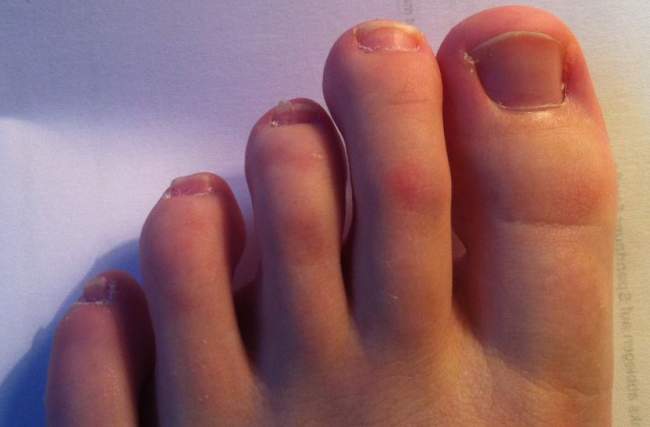 Nägel vor dem Schneiden (alle drei Nägel links haben das Problem) Fußnägel verformt in Nagelkrankheiten