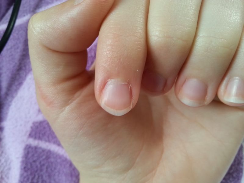 Draufsicht auf den verformten Nagel am Zeigefinger Warum sind meine Nägel so komisch verformt? in Nagelkrankheiten