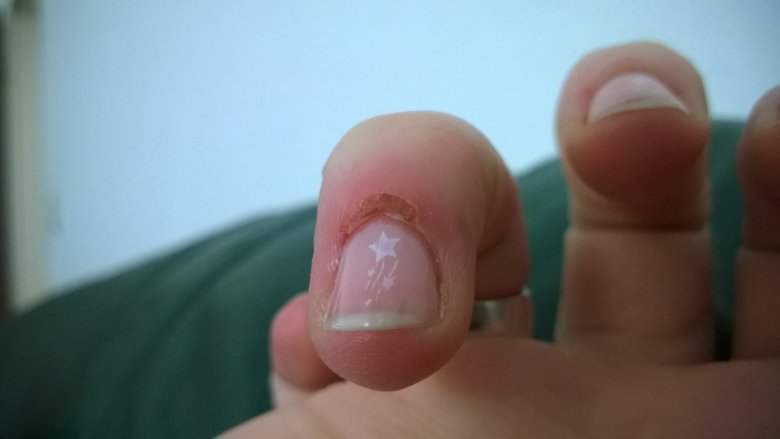 Finger kaputt Nagelhaut kaputt in Maniküre