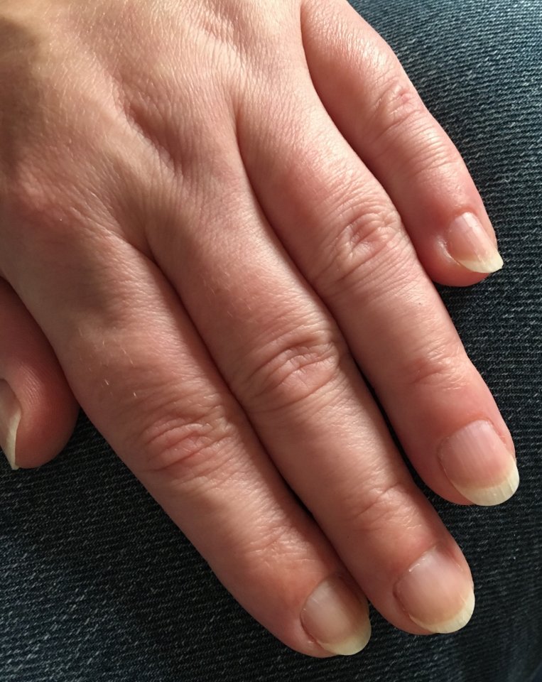 Ist Zustand Jahrzehntelange Nagelkauerrin im Kampf gegen sich in Nägel kauen