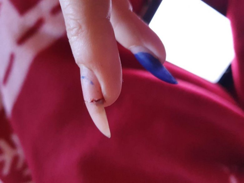 Zersplittert Gel nagel zur Hälfte fast abgerissen  in Gelnägel