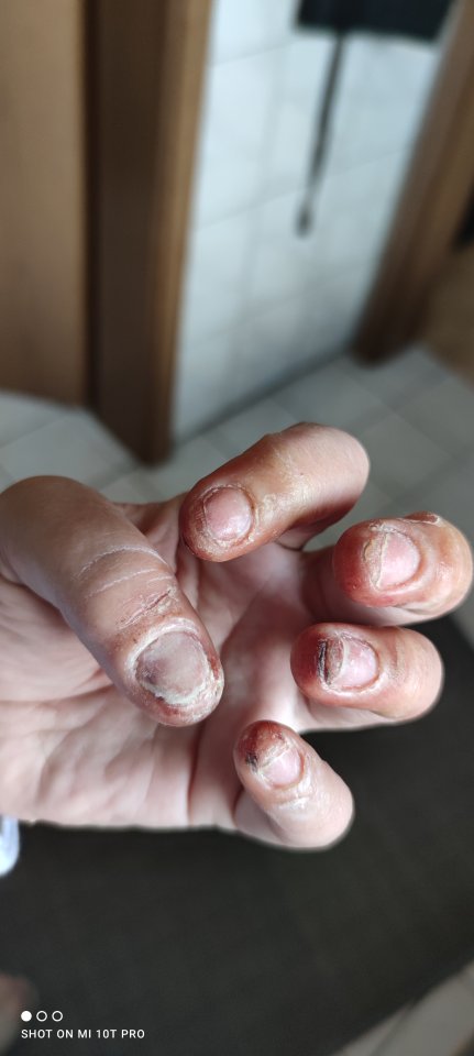 Linke hand Ist das einer Allergie oder etwas anderes? in Gelnägel
