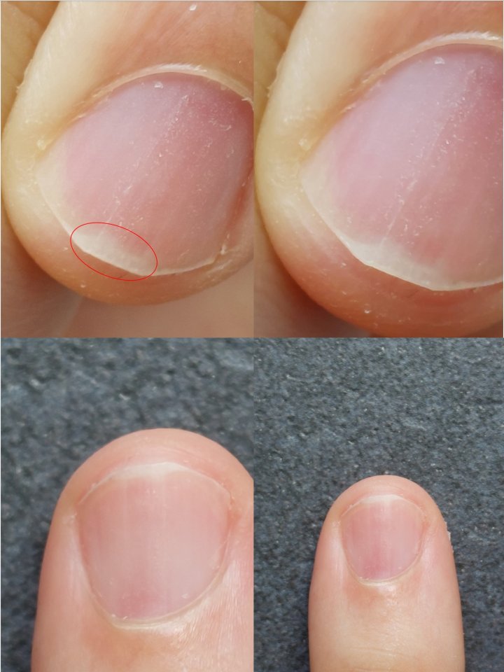 Nageldefekt Haut/gewebe unter Fingernagel beschädigt in Nagelkrankheiten
