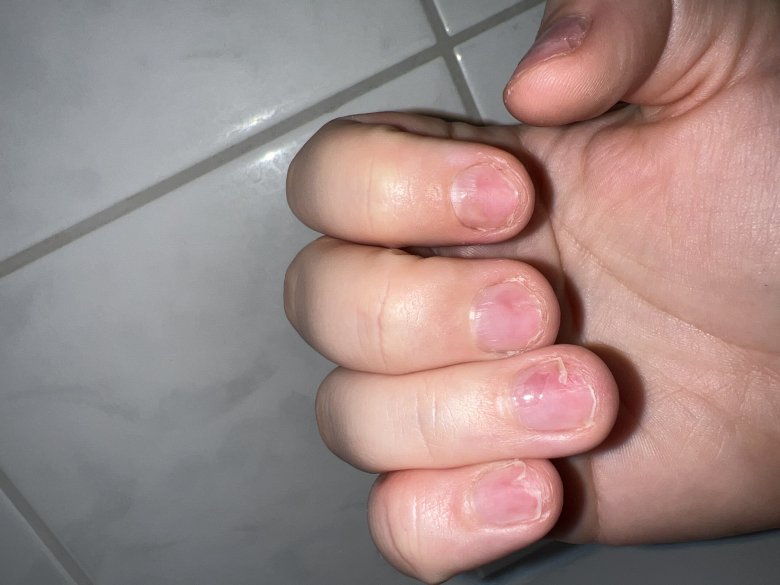 Rechte Hand Ringfinger und kleiner Finger gespalten und nagelplatte zum Teil ab Nägel kaputt nach Gelmodellage in Maniküre