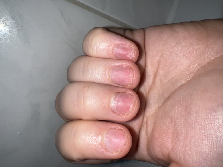 Linke Hand, kleiner Finger Nagel gespalten Nägel kaputt nach Gelmodellage in Maniküre
