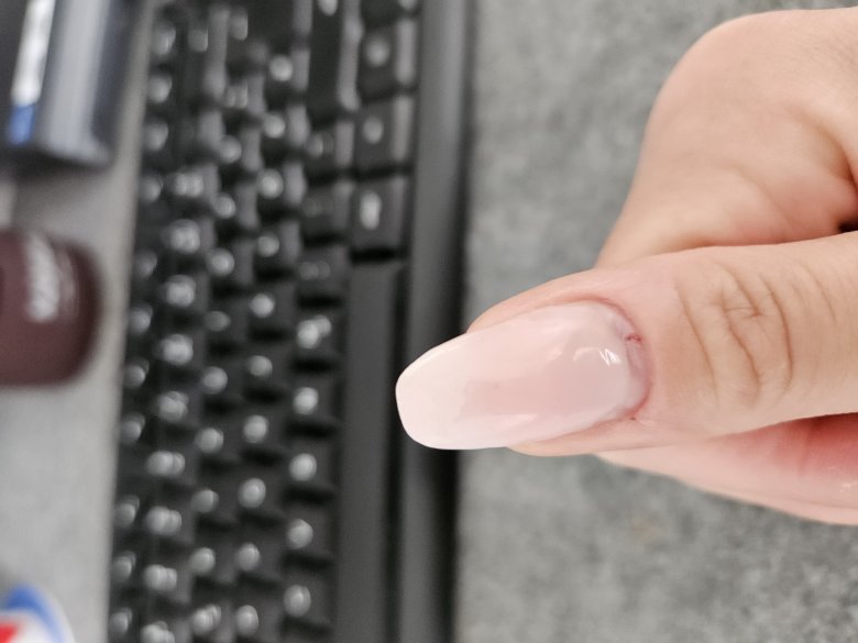 Daumen rechts was ist das? naturnagel verformt? in Nagelkrankheiten