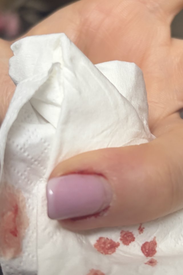 Nagelbettablösung (Onycholyse) nach Stoß TW  Hilfe! Nagelbettablösung  Onycholyse  nach Stoß in Nagelmodellagen