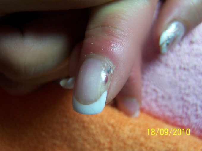 1.ansicht nagelpilz? in Nagelkrankheiten