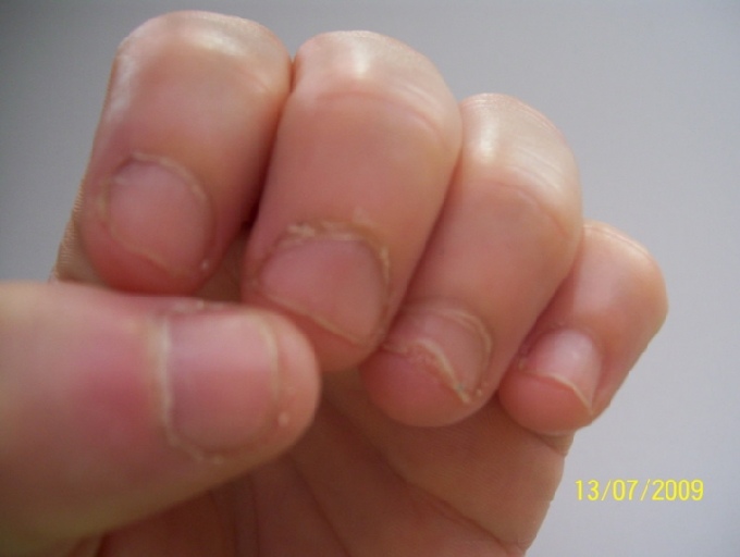 linke Hand 13.07.09
die Nägel waschsen besonders die Nagelhaut und der untere  Mit 40 Nägel kauen in Nägel kauen