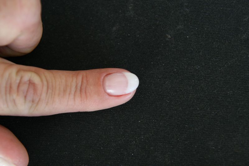 von oben Neuaufbau abgelöstes Gel - bitte beurteilen in Anfänger Nageldesign