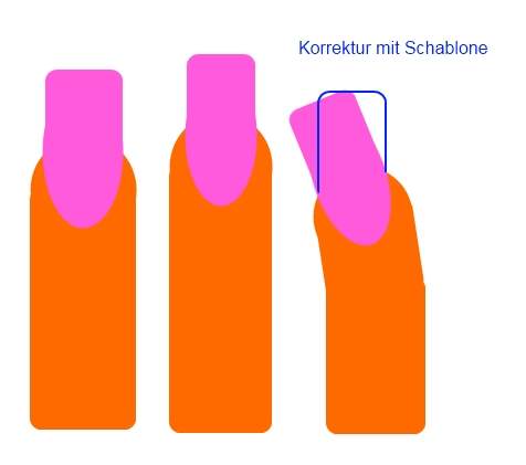 Korrektur eines schiefen Fingers mit Schablone. Verkippter Nagel in Nageldesign