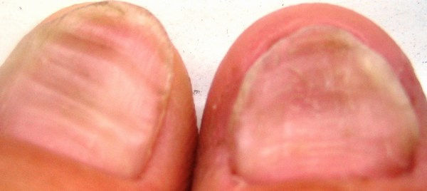 Verformung durch Schuppenflechte Schuppenflechte (Psoriasis auf Nägeln) in Nagelkrankheiten