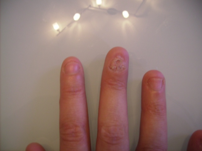 Nagel Patella Syndrom - Fehlende Nägel Hautkrankheit - fehlende Fingernägel & Fußnägel in Nagelkrankheiten