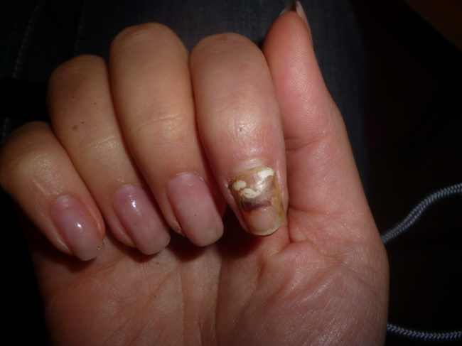 ca 15 wochen nach dem unfall
der nagel hebt sich lansam ab bildertagebuch von meinem zeigefingerkuppenbruch in Nagelkrankheiten