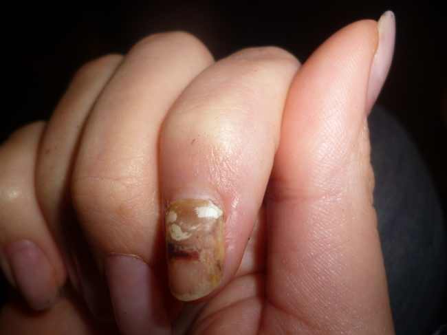 auch ca 15 wochen nach dem unfall. hier sieht man besser wie der alte nagel  Bildertagebuch von meinem zeigefingerkuppenbruch in Nagelkrankheiten