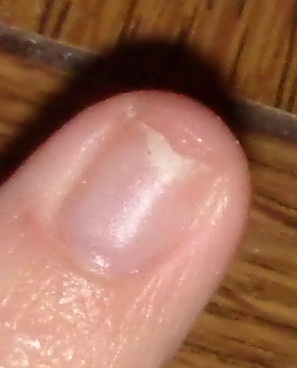 Fingernagel splittert
