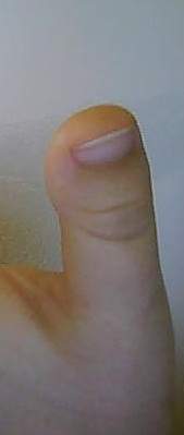 Linker Daumen - entschuldigt bitte die schlecht quali meiner cam Brachydaktylie/ stark verbreiterter Daumen(nagel) in Nagelkrankheiten
