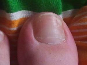 Nagel links Komisch aussehende Nägel, wächst ein neuer Nagel? in Nagelkrankheiten