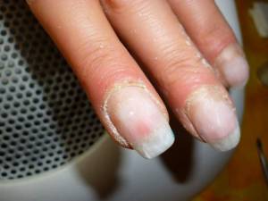 Nagelhaut Sehr Dick Manikure Naturnagel Nagelpflege