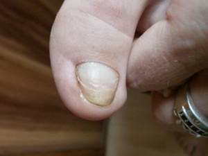  was passiert mit diesen nägeln? in Nagelkrankheiten
