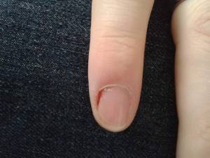 Nagelbettentzündung wildes fleisch finger