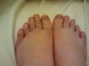 deformierte Fußnägel 3 Krüppel-Füße und Nägel - was tun? in Pediküre