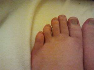 deformierte Fußnägel 2 Krüppel-Füße und Nägel - was tun? in Pediküre