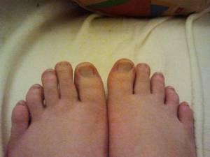 deformierte Fußnägel 1 Krüppel-Füße und Nägel - was tun? in Pediküre