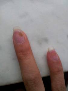 Ringfinger und kleiner Finger der rechten Hand - Greenie? Greenie oder doch schlimmer? in Nagelkrankheiten