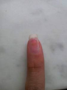 Kleiner Finger der rechten Hand - Greenie? Greenie oder doch schlimmer? in Nagelkrankheiten