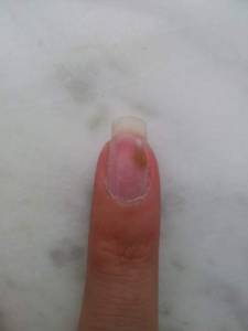 Ringfinger der rechten Hand - Greenie? Greenie oder doch schlimmer? in Nagelkrankheiten
