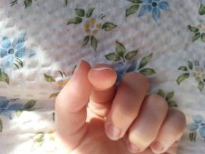Ansicht von vorn auf den stark verformten Nagel am Zeigefinger Warum sind meine Nägel so komisch verformt? in Nagelkrankheiten