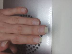 Das sind ihre nägel Ist das nagelpilz in Nagelkrankheiten