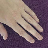 fehlende Fingernägel Hautkrankheit - fehlende Fingernägel & Fußnägel in Nagelkrankheiten