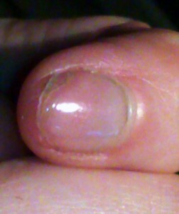 zeigefinger Extrem eingerissene Naturnägel! in Nagelkrankheiten