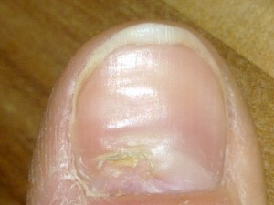 Daumen mit eingerissener Nagelplatte o. ä. Gel auf verletzten Nagel? in Nagelkrankheiten