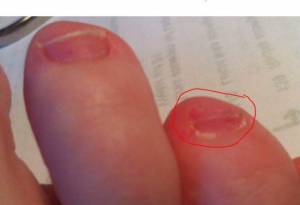 Sehr kurzer Nagel nach dem Schneiden Fußnägel verformt in Nagelkrankheiten