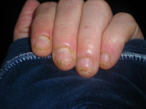Fingernagel eiter unterm Nagelentzündung »