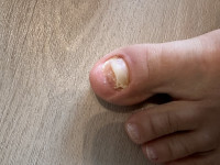 Abgerissener nagel HILFE    Achtung abgerissener Zehennagel brüchig,rissig in Nagelkrankheiten