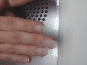 Das ist die andere hand ist das nagelpilz in Nagelkrankheiten
